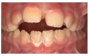 before treatment teeth photo