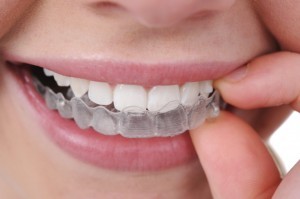 Invisalign braces