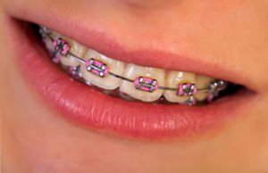 How Braces img